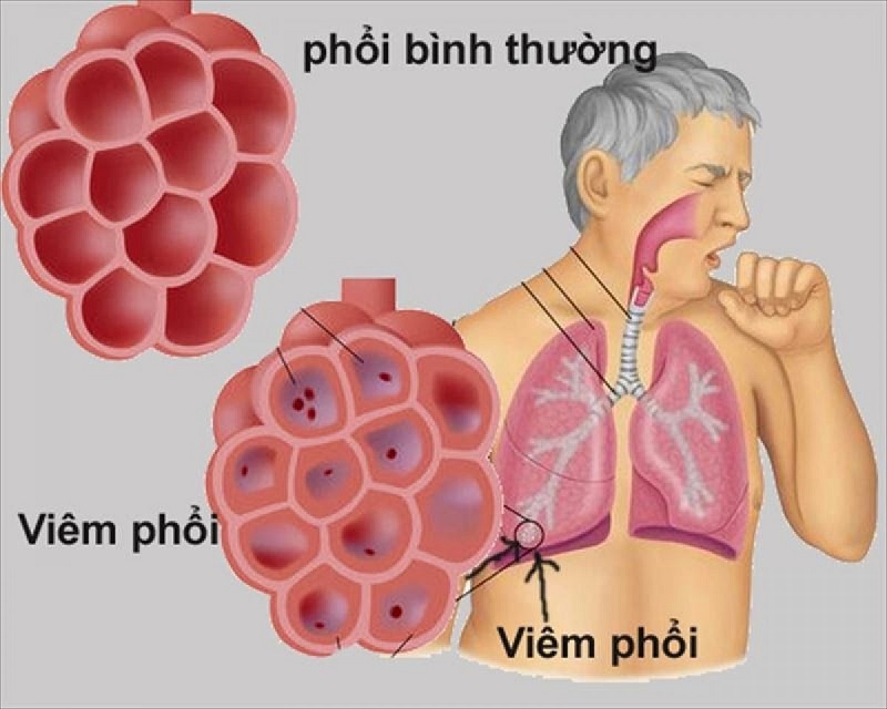 Viêm phổi là một trong những di chứng nguy hiểm do hậu COVID-19 gây nên 