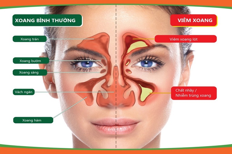 Viêm Mũi Có Lây Không? Tìm Hiểu Nguyên Nhân Và Cách Phòng Tránh Hiệu Quả