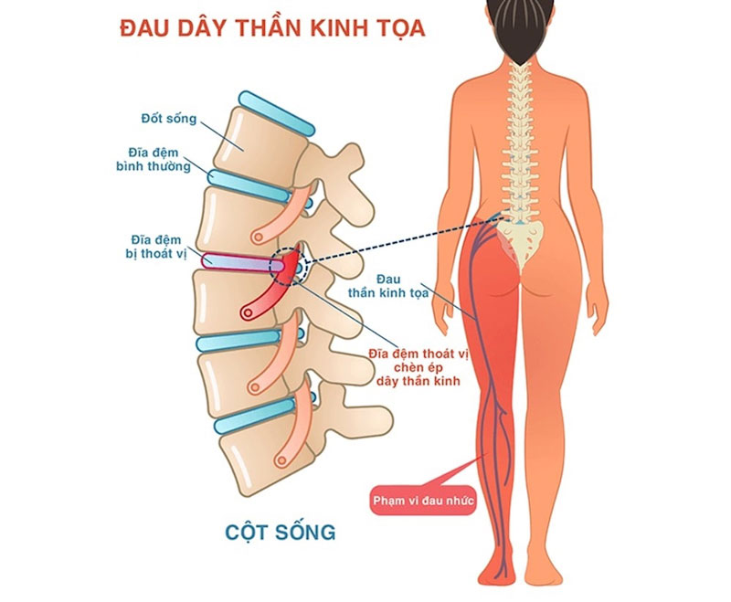 Đau thần kinh tọa là gì?