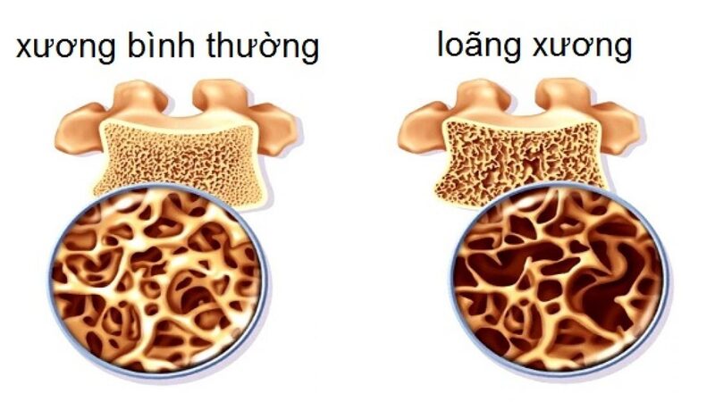 Bệnh lý tuyến giáp cũng có thể dẫn đến loãng xương