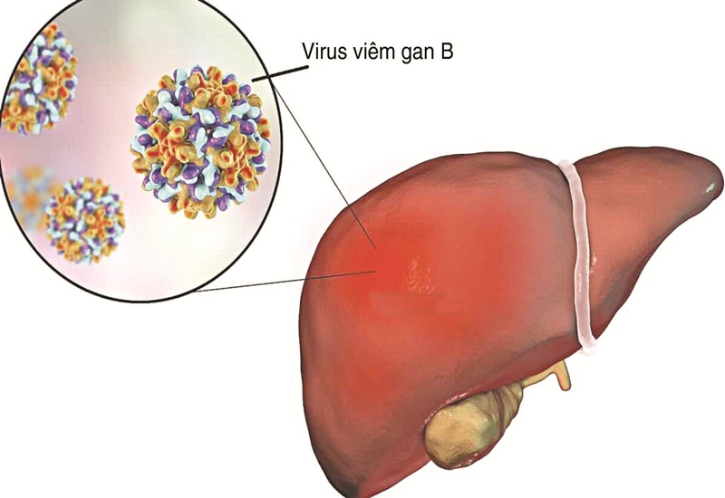 Viêm gan B do virus HBV gây ra