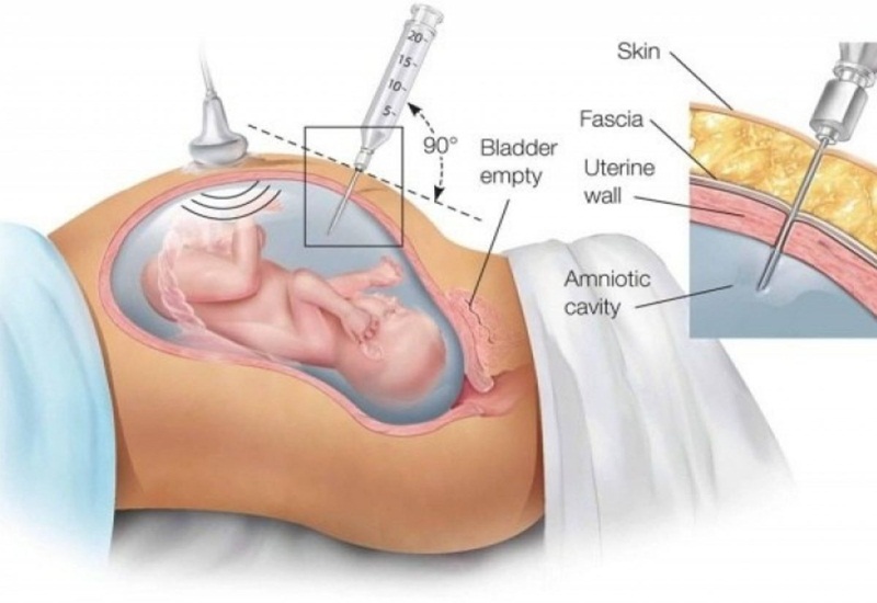 Phương pháp chọc ối tiềm ẩn một số nguy cơ rủi ro nhất định