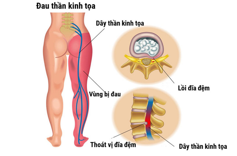 Tổng quan về tình trạng đau thần kinh tọa