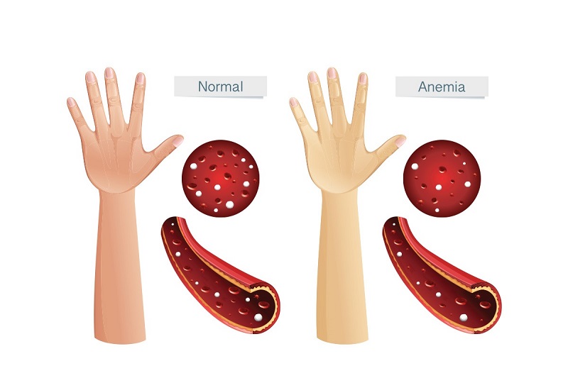 Bệnh nhân bị Anemia thường có dấu hiệu vàng da, niêm mạc