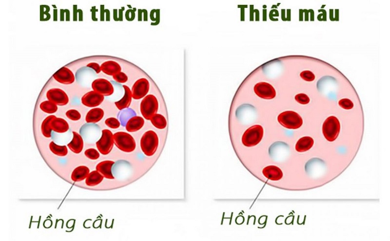 Thiếu máu là một bệnh lý phổ biến nhưng rất nhiều người không biết nguyên nhân thiếu máu là gì