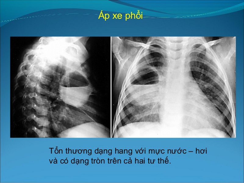 Hình ảnh chụp X-quang bệnh nhân áp xe phổi