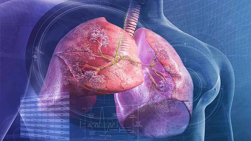 Áp xe phổi có thể gây nên những biến chứng nguy hiểm khi không được điều trị sớm