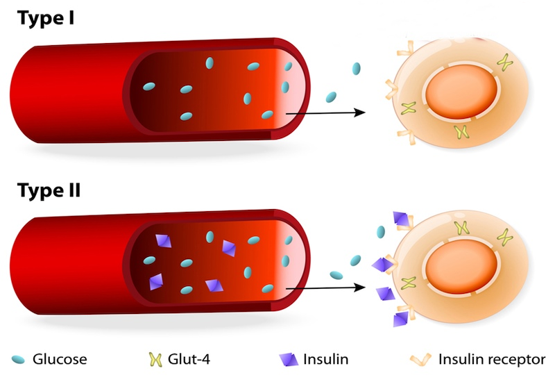 Tiểu đường type 1: vắng “chìa khóa" Insulin, Glucose không xâm nhập được vào tế bào. Tiểu đường type 2: kháng Insulin, Glucose bị đọng lại trong máu.