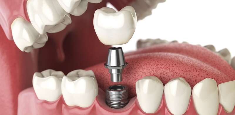  Cấy ghép implant là phương pháp trồng răng có nhiều ưu điểm