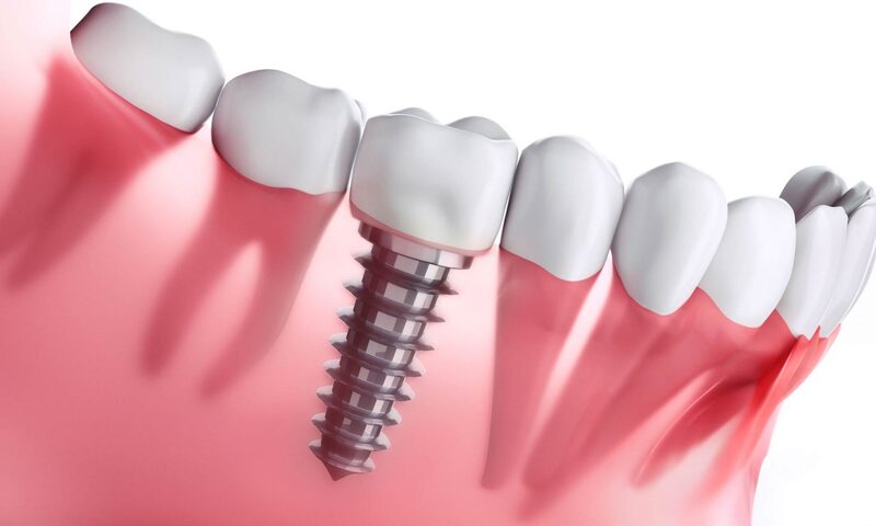 Cấy ghép implant không ảnh hưởng đến các răng bên cạnh