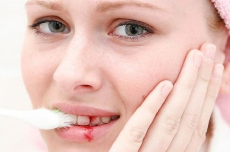 Nguyên nhân dẫn đến chảy máu chân răng và cách khắc phục