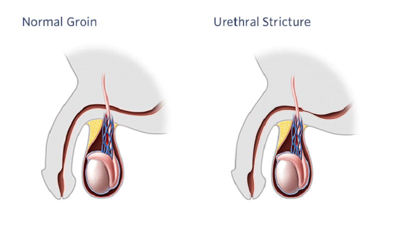 Hẹp niệu đạo là căn bệnh ảnh hưởng rất nhiều đến cuộc sống và sinh hoạt của người bệnh