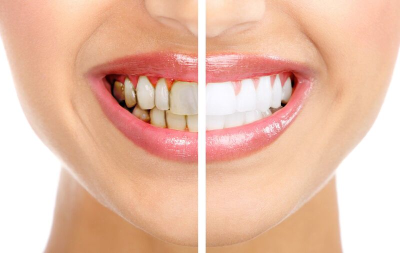 Nguyên nhân khiến răng ố màu và cách tẩy trắng răng an toàn | Medlatec