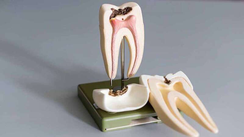 Viêm tủy răng nguyên nhân do đâu và cách xử lý | Medlatec