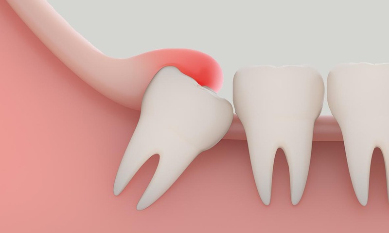 Răng khôn mọc lệch có thể gây biến chứng gì và lưu ý khi nhổ