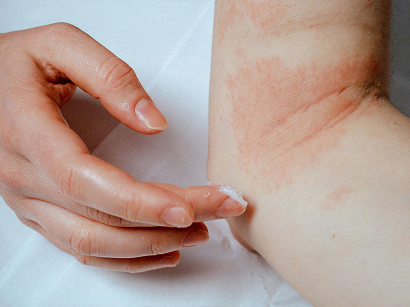 Dưỡng ẩm là một trong những cách phòng ngừa bệnh eczema