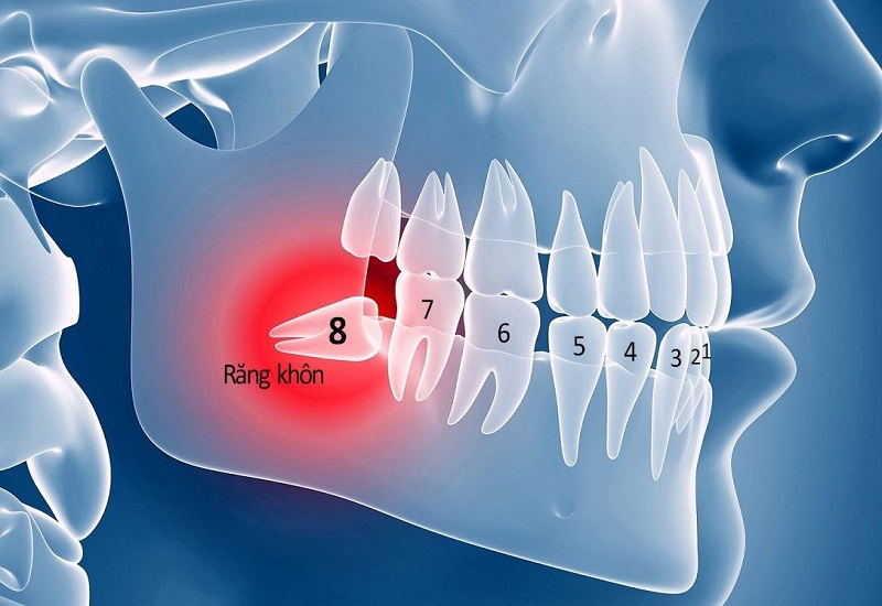 Răng khôn mọc lệch gây ra nhiều hệ lụy xấu cho sức khỏe