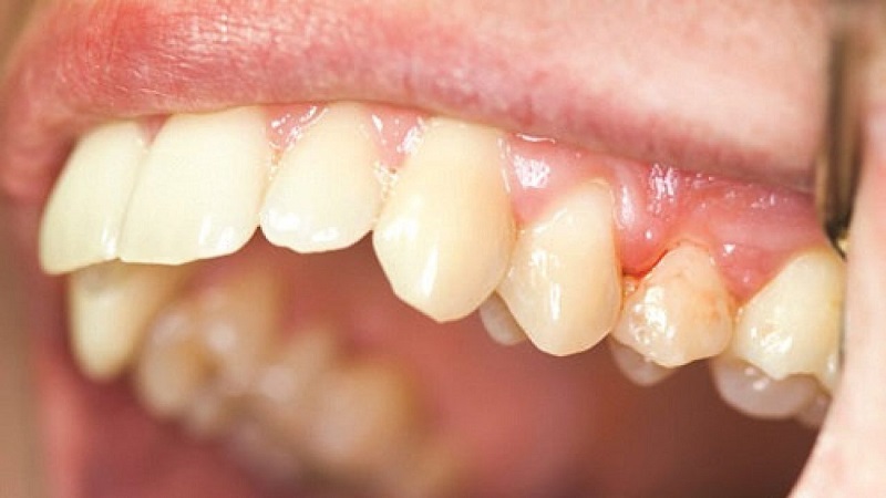 Người đang bị viêm nha chu không nên lấy cao răng