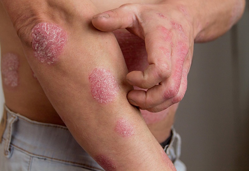 Những nguyên nhân nào gây bệnh chàm da? Phương pháp điều trị bệnh ra sao? | Medlatec