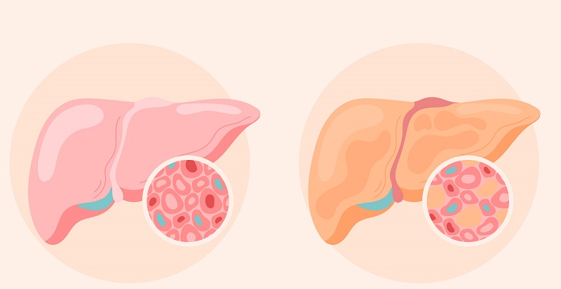 Gan nhiễm mỡ là bệnh lý khá phổ biến