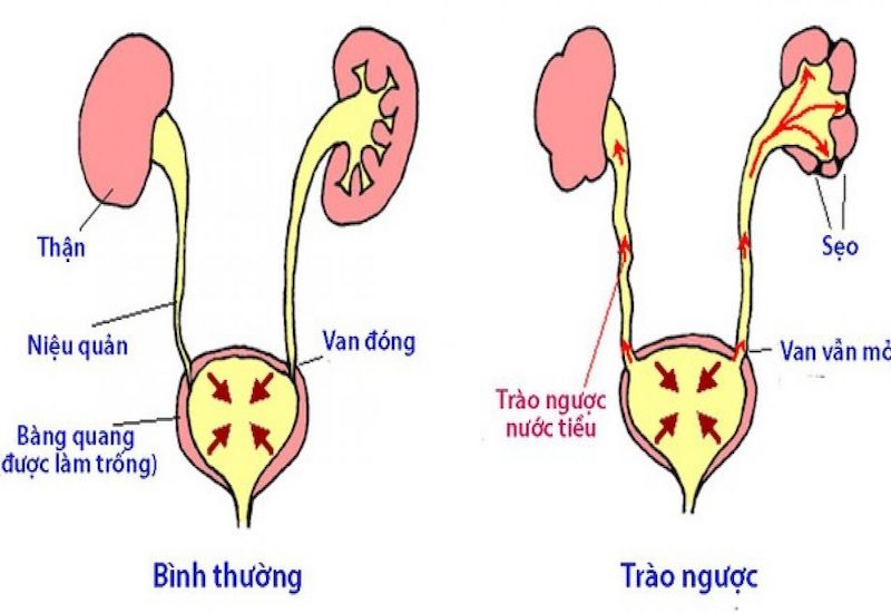 Hình ảnh mô phỏng tình trạng trào ngược bàng quang niệu quản