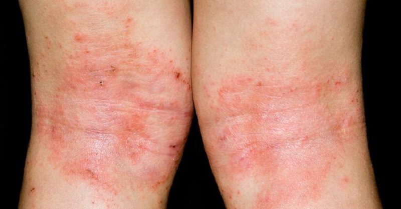 Bệnh chàm là một trong những tác nhân gây nên các nốt đỏ ngứa trên da