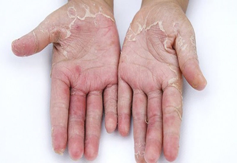 Chữa chàm da tay bằng cách nào? Phương pháp phòng ngừa ra sao? | Medlatec