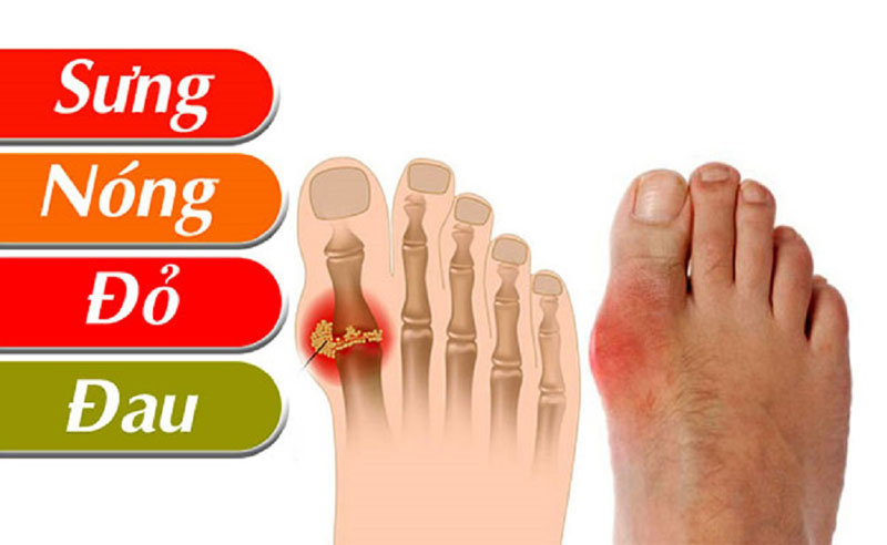 Người bị gout thường có những biểu hiện gì?