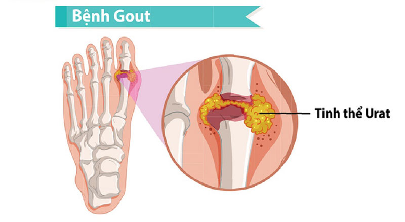 Tìm hiểu bệnh gout là gì?