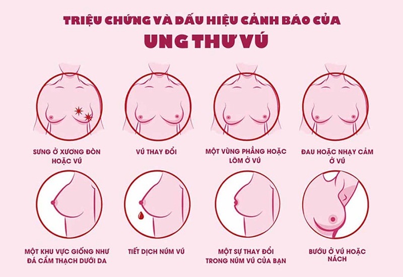 Một số triệu chứng ung thư vú thường gặp