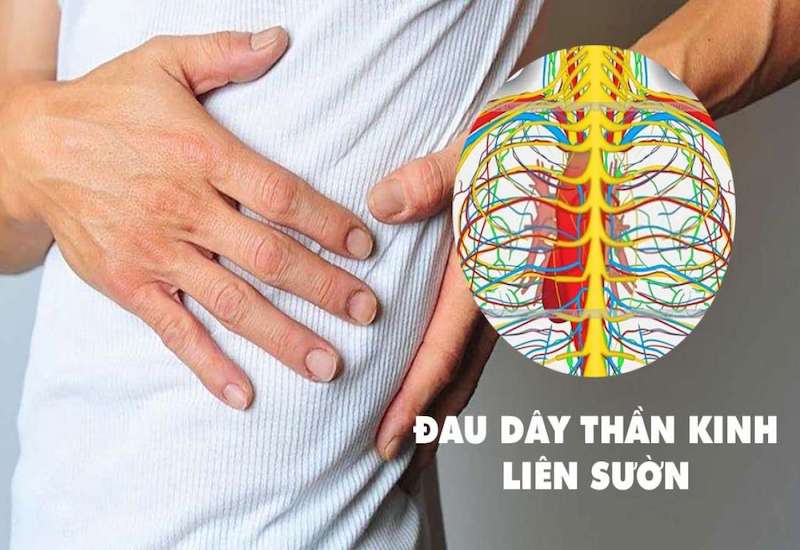 Vị trí dây thần kinh liên sườn