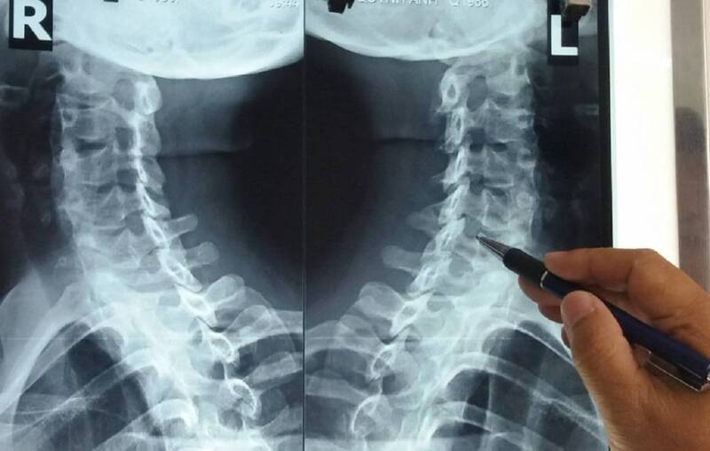 Chẩn đoán thoái hóa cột sống thắt lưng bằng chụp X-quang