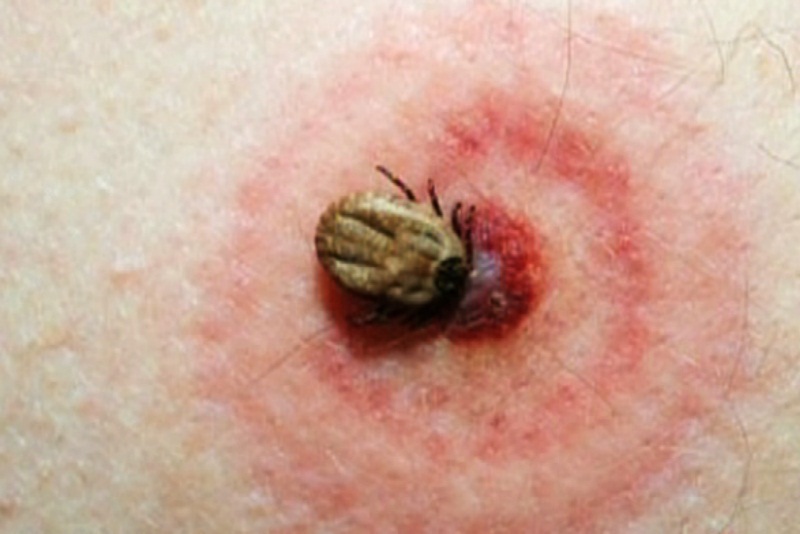 Bọ ve chân đen - vật chủ truyền nhiễm bệnh Lyme