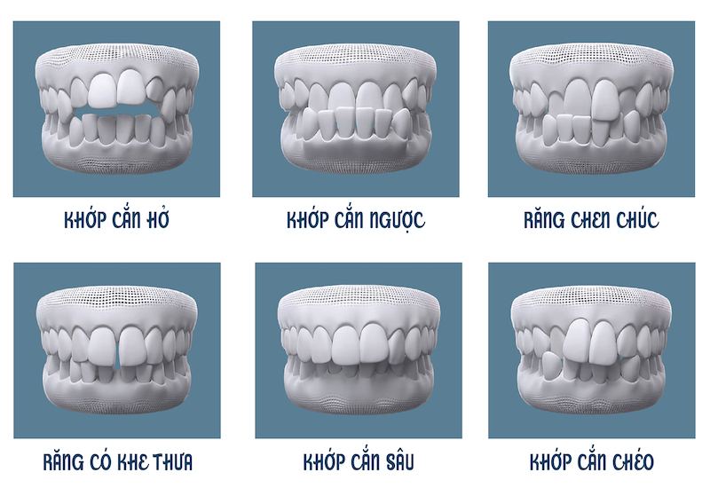 Những tình trạng răng nên thực hiện điều chỉnh bằng phương pháp niềng