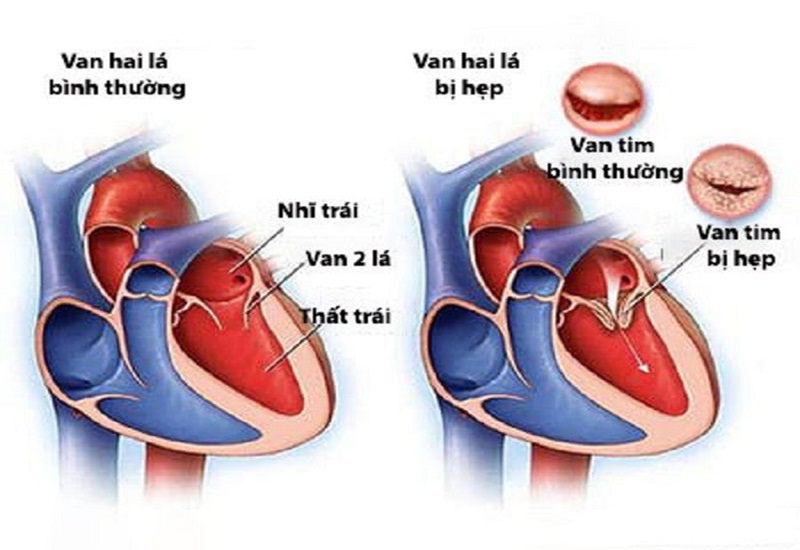 Nhiều nguyên nhân gây ra bệnh hẹp van hai lá