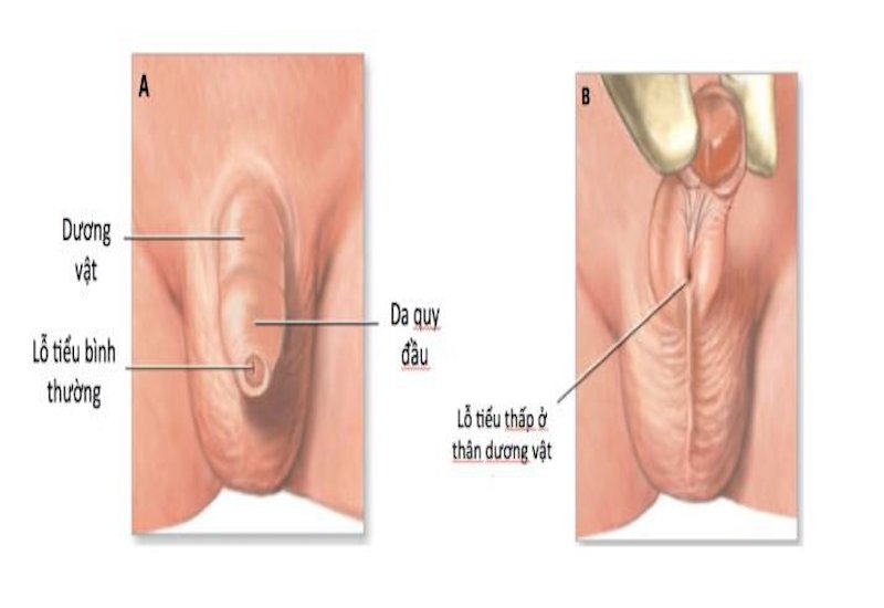 Mô phỏng tình trạng lỗ tiểu thấp ở các bé trai