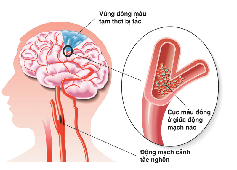 Các vấn đề mạch máu não có thể gây ra rối loạn tâm thần thực tổn