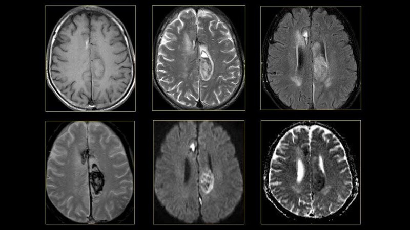Chụp MRI để kiểm tra nguyên nhân gây rối loạn tiền đình