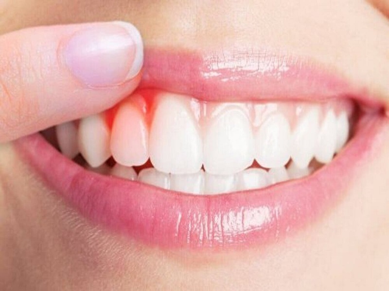Chảy máu chân răng có thể khắc phục triệt để được không? 
