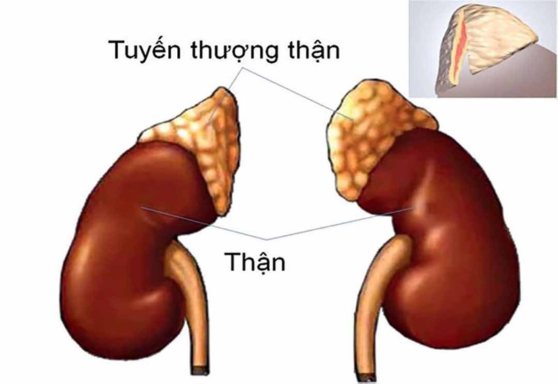 Tuyến thượng thận tăng tiết aldosteron quá mức có thể gây hội chứng Conn