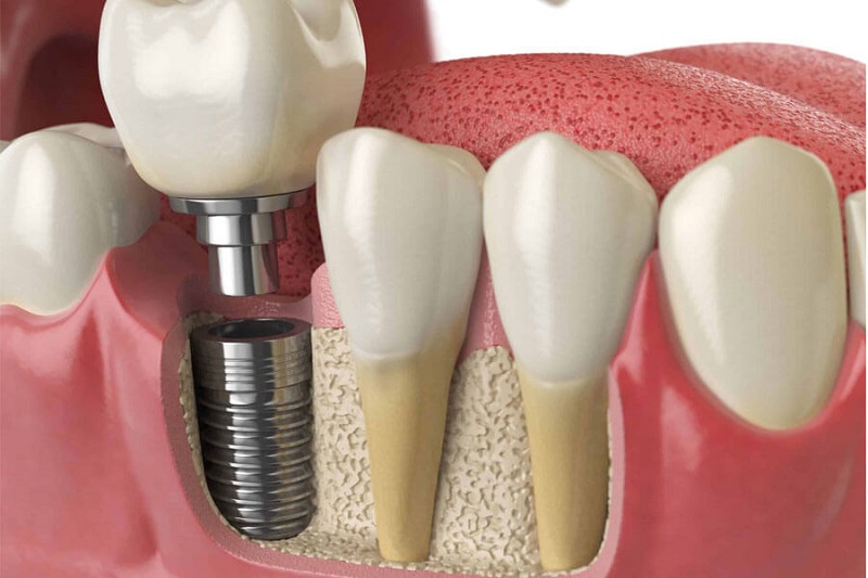 Chất liệu làm trụ Implant có độ tương thích cao với xương hàm