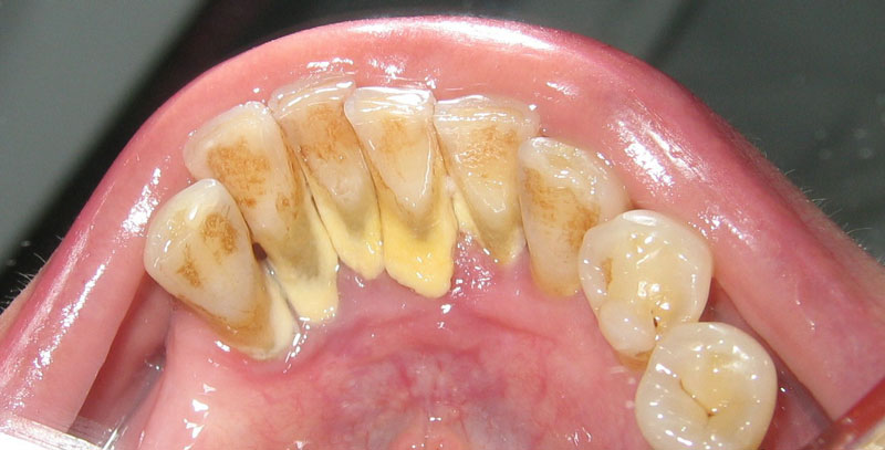Mảng bám đen trên răng là bệnh lý không nên chủ quan