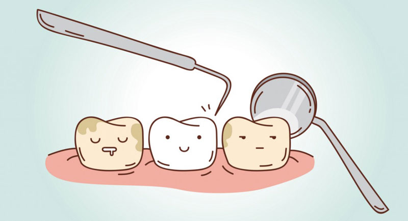Lấy cao răng tại phòng nhà để loại bỏ mảng bám cứng đầu trên răng