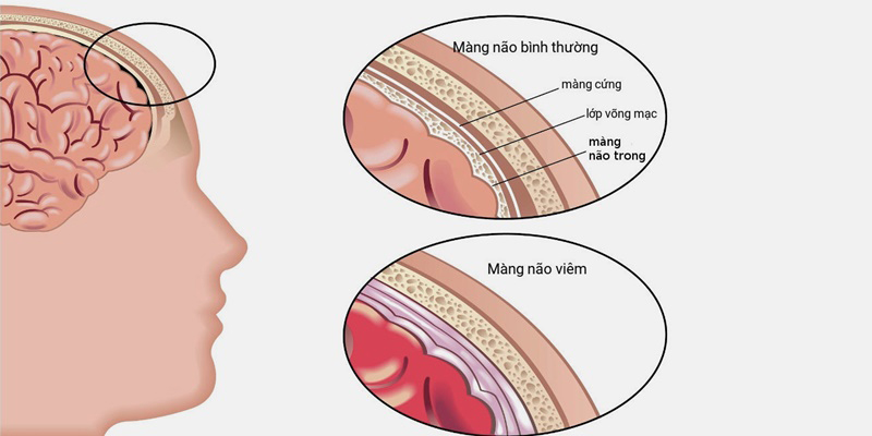 Hình ảnh mô phỏng màng não viêm và màng não bình thường