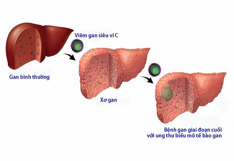 Ảnh hưởng của viêm gan C đối với gan