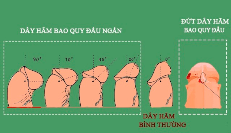 Dây hãm bao quy đầu ngắn có thể bị đứt khi dương vật căng cứng quá mức