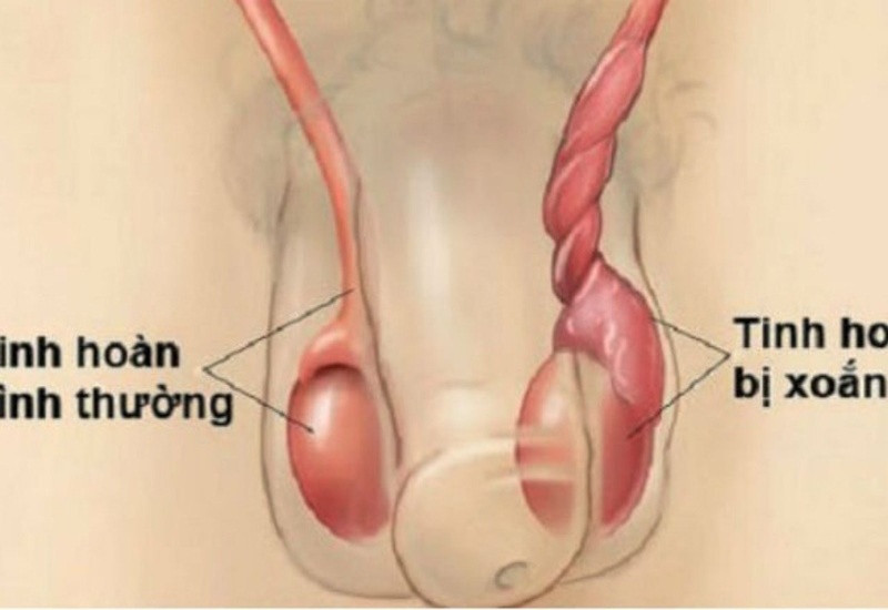 Xoắn tinh hoàn thường xảy ra ở trẻ sơ sinh và trẻ nhỏ