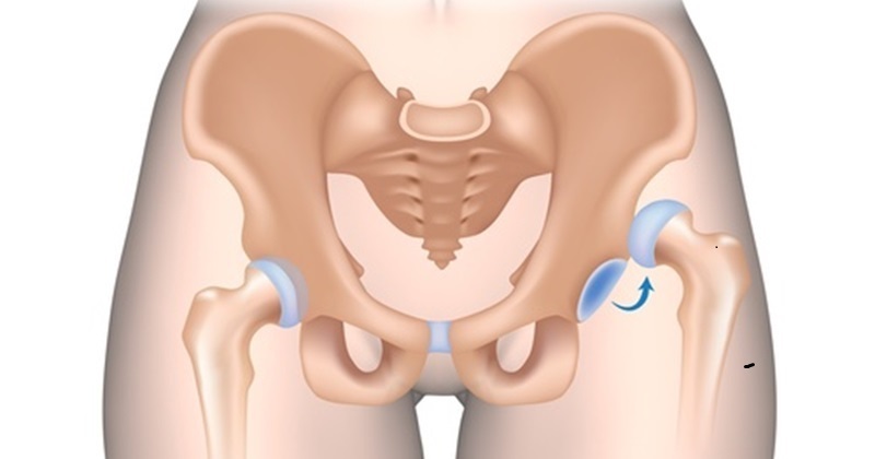 Chỏm xương đùi có thể bị trật khỏi ổ chảo khớp háng do ngoại lực tác động mạnh