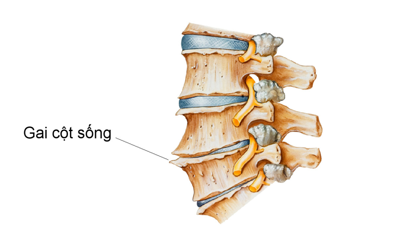 4. Các phương pháp điều trị bệnh gai cột sống