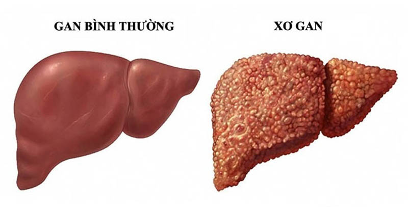 Mô phỏng lá gan bình thường và lá gan bị xơ gan mất bù